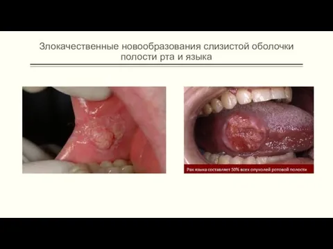 Злокачественные новообразования слизистой оболочки полости рта и языка