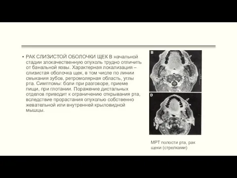 РАК СЛИЗИСТОЙ ОБОЛОЧКИ ЩЕК В начальной стадии злокачественную опухоль трудно отличить от банальной