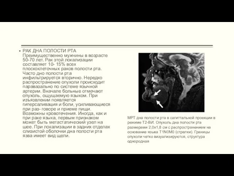 РАК ДНА ПОЛОСТИ РТА Преимущественно мужчины в возрасте 50-70 лет.