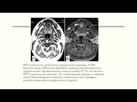 МРТ полости рта, ротоглотки в аксиальной проекции, Т1-ВИ. Опухоль языка небольших размеров, границы