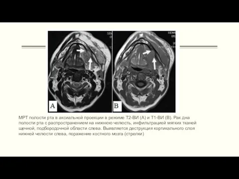 МРТ полости рта в аксиальной проекции в режиме Т2-ВИ (А) и Т1-ВИ (В).