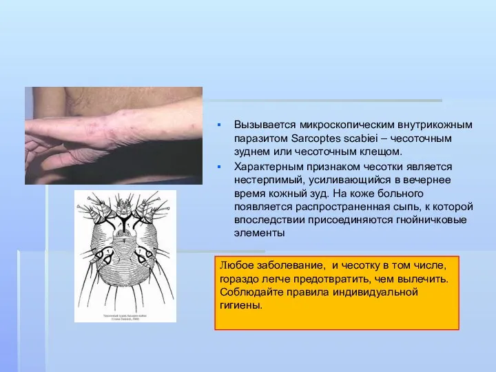 Чесотка Вызывается микроскопическим внутрикожным паразитом Sarcoptes scabiei – чесоточным зуднем