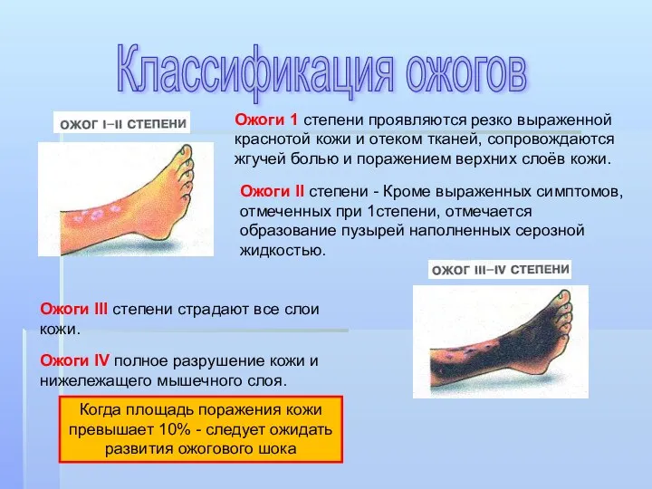 Ожоги 1 степени проявляются резко выраженной краснотой кожи и отеком