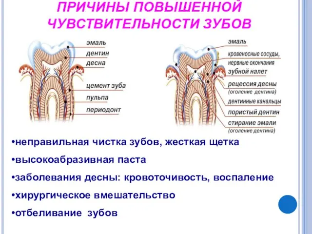 ПРИЧИНЫ ПОВЫШЕННОЙ ЧУВСТВИТЕЛЬНОСТИ ЗУБОВ неправильная чистка зубов, жесткая щетка высокоабразивная