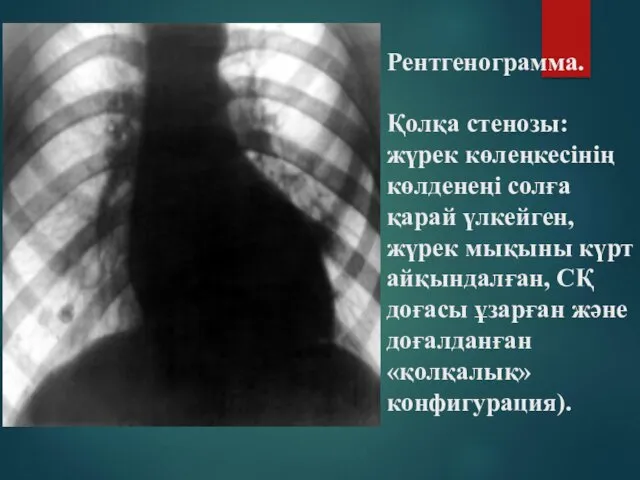 Рентгенограмма. Қолқа стенозы: жүрек көлеңкесінің көлденеңі солға қарай үлкейген, жүрек мықыны күрт айқындалған,