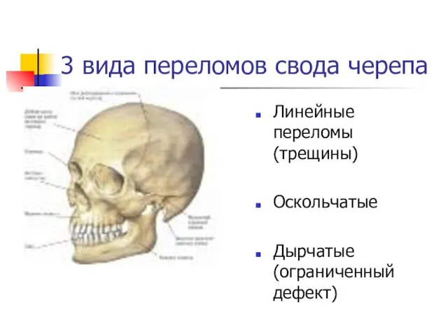 3 вида переломов свода черепа Линейные переломы (трещины) Оскольчатые Дырчатые (ограниченный дефект)