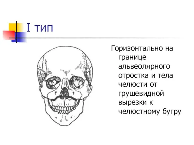 I тип Горизонтально на границе альвеолярного отростка и тела челюсти от грушевидной вырезки к челюстному бугру