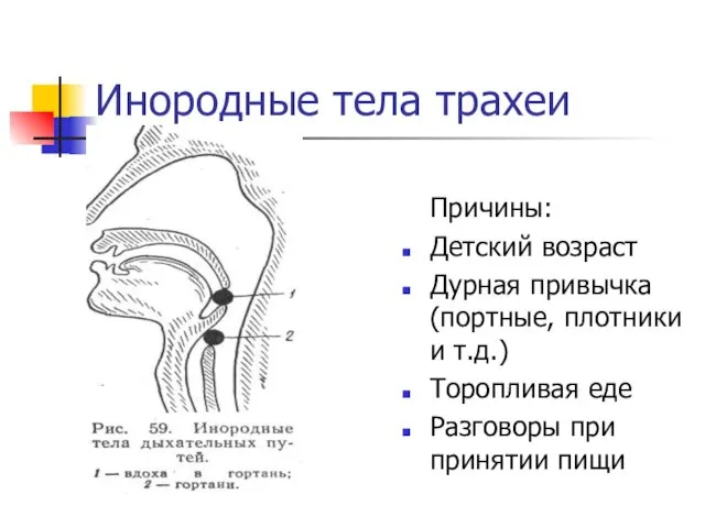 Инородные тела трахеи Причины: Детский возраст Дурная привычка (портные, плотники