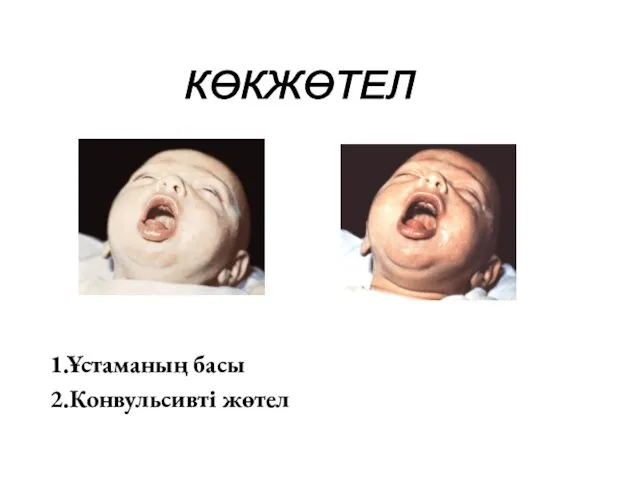 1.Ұстаманың басы 2.Конвульсивті жөтел КӨКЖӨТЕЛ