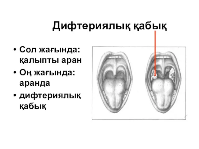 Дифтериялық қабық Сол жағында: қалыпты аран Оң жағында: аранда дифтериялық қабық