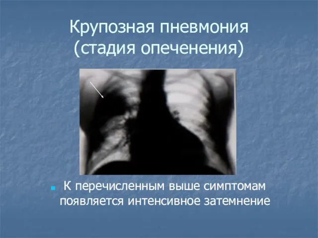Крупозная пневмония (стадия опеченения) К перечисленным выше симптомам появляется интенсивное затемнение