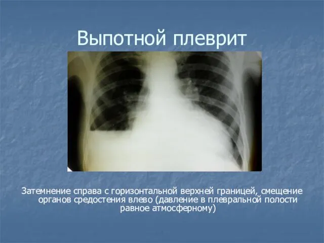 Выпотной плеврит Затемнение справа с горизонтальной верхней границей, смещение органов