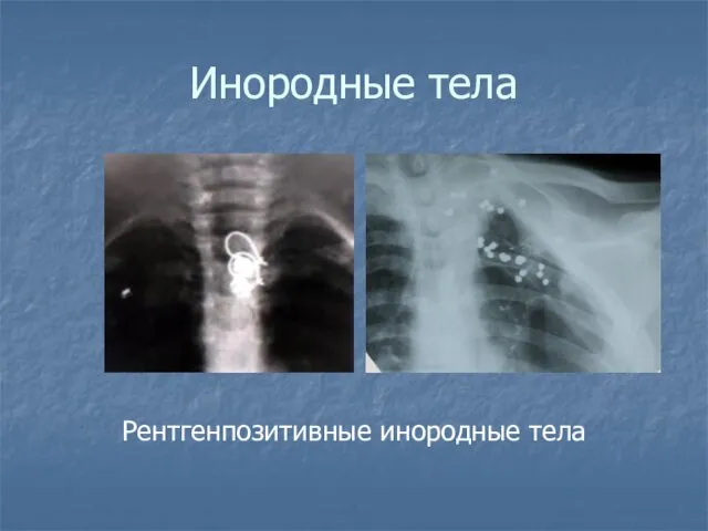Инородные тела Рентгенпозитивные инородные тела