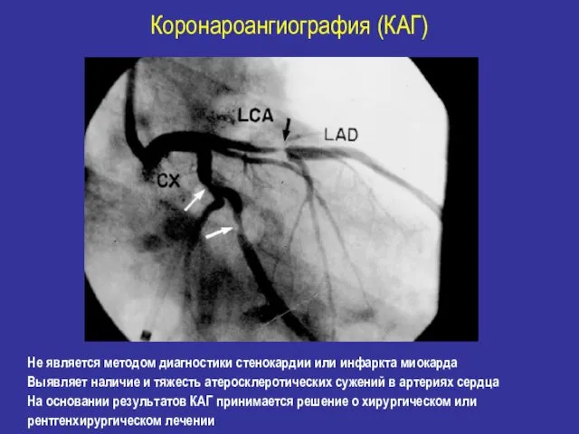 Коронароангиография (КАГ) Не является методом диагностики стенокардии или инфаркта миокарда
