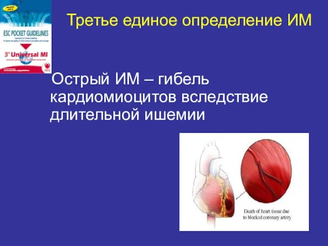 Третье единое определение ИМ Острый ИМ – гибель кардиомиоцитов вследствие длительной ишемии
