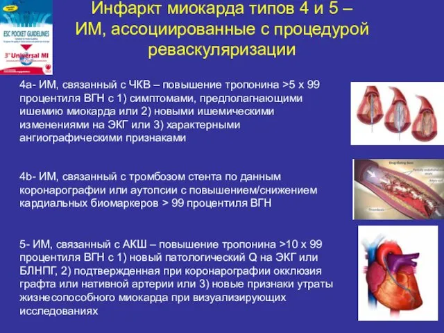 Инфаркт миокарда типов 4 и 5 – ИМ, ассоциированные с