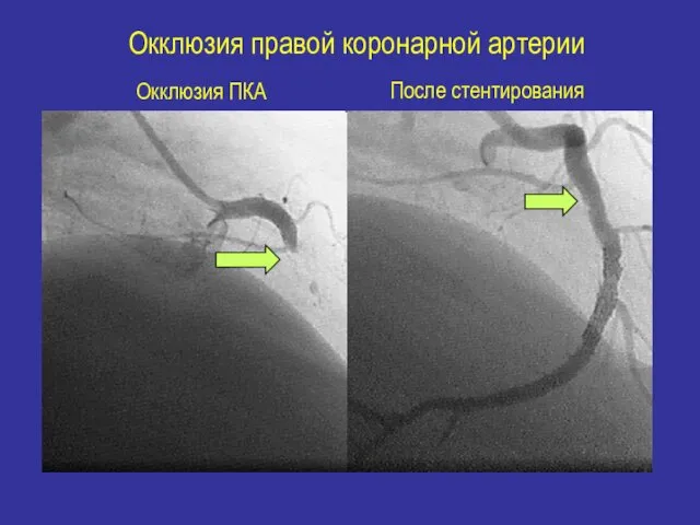 Окклюзия правой коронарной артерии Окклюзия ПКА После стентирования