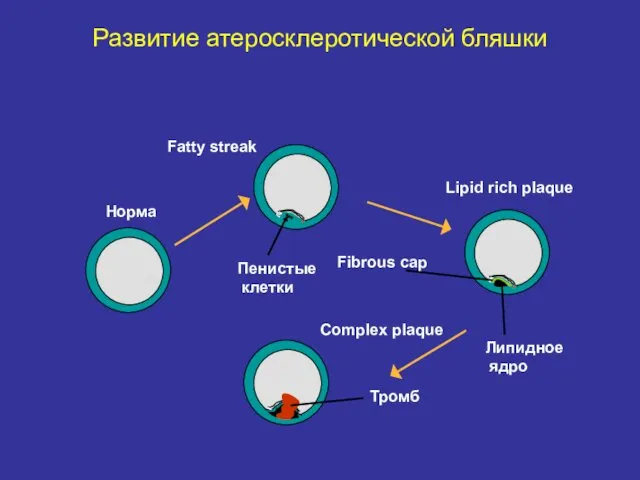 Норма Fatty streak Lipid rich plaque Complex plaque Тромб Липидное