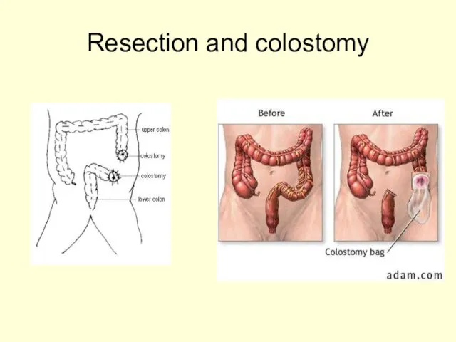 Resection and colostomy