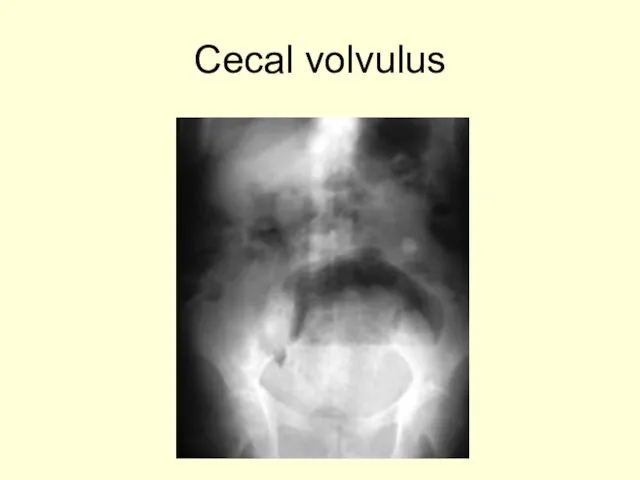 Cecal volvulus