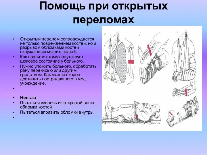 Помощь при открытых переломах Открытый перелом сопровождается не только повреждением