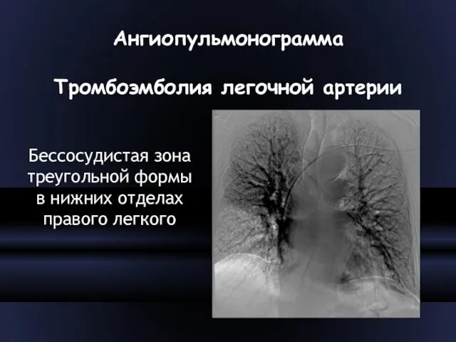 Ангиопульмонограмма Тромбоэмболия легочной артерии Бессосудистая зона треугольной формы в нижних отделах правого легкого
