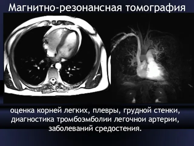 Магнитно-резонансная томография оценка корней легких, плевры, грудной стенки, диагностика тромбоэмболии легочнои артерии, заболеваний средостения.