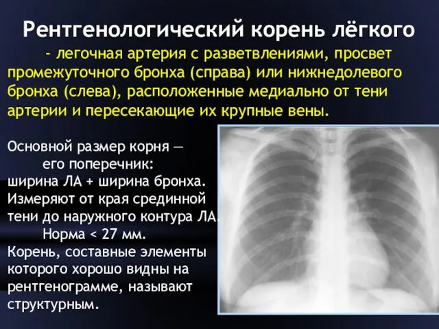 Рентгенологический корень лёгкого - легочная артерия с разветвлениями, просвет промежуточного бронха (справа) или