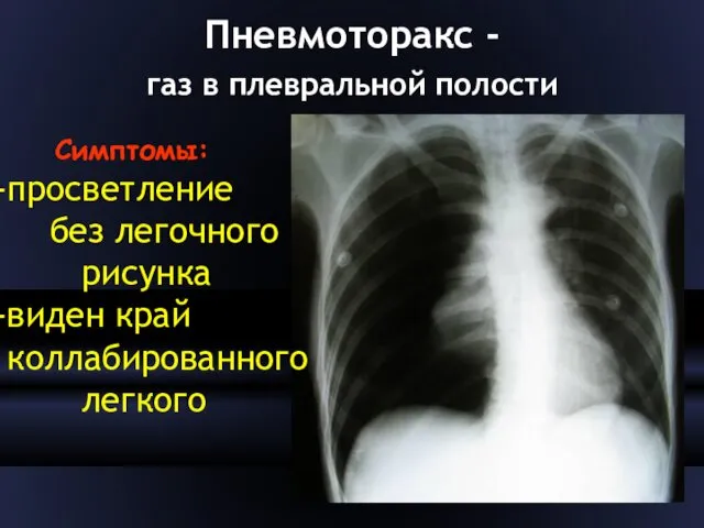 Пневмоторакс - газ в плевральной полости Симптомы: просветление без легочного рисунка виден край коллабированного легкого