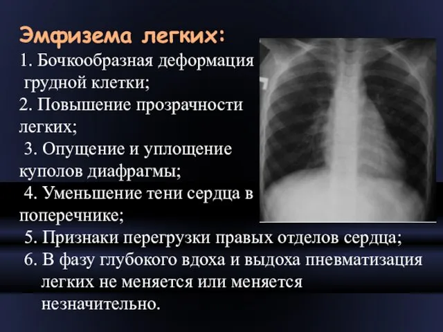 Эмфизема легких: 1. Бочкообразная деформация грудной клетки; 2. Повышение прозрачности легких; 3. Опущение
