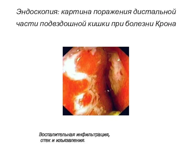 Эндоскопия: картина поражения дистальной части подвздошной кишки при болезни Крона Воспалительная инфильтрация, отек и изъязвления.