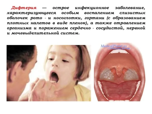 Дифтерия — острое инфекционное заболевание, характеризующееся особым воспалением слизистых оболочек