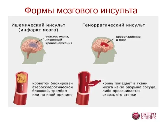 Формы мозгового инсульта