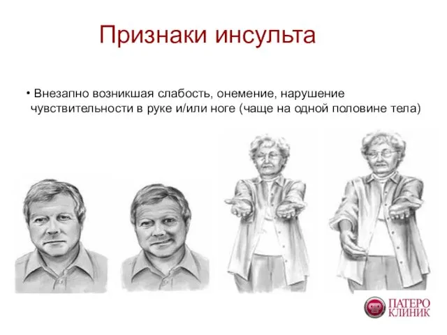 Признаки инсульта Внезапно возникшая слабость, онемение, нарушение чувствительности в руке