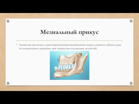 Мезиальный прикус Аномалия окклюзии, характеризующаяся выдвижением вперед нижнего зубного ряда