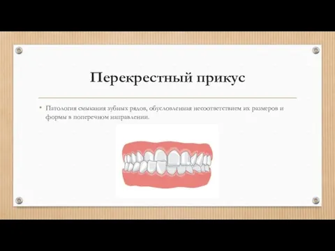 Перекрестный прикус Патология смыкания зубных рядов, обусловленная несоответствием их размеров и формы в поперечном направлении.