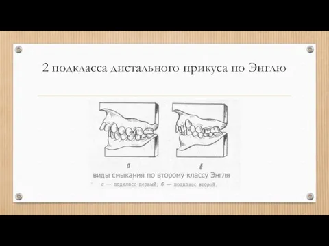 2 подкласса дистального прикуса по Энглю