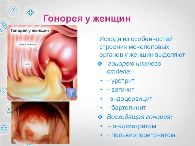 Гонорея у женщин Исходя из особенностей строения мочеполовых органов у