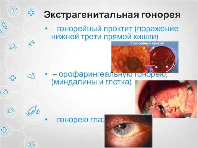 Экстрагенитальная гонорея – гонорейный проктит (поражение нижней трети прямой кишки)