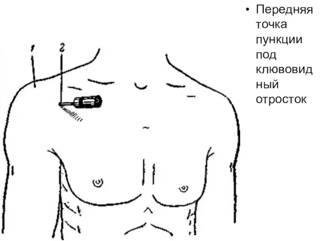 Передняя точка пункции под клювовидный отросток