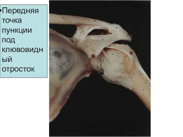 Передняя точка пункции под клювовидный отросток