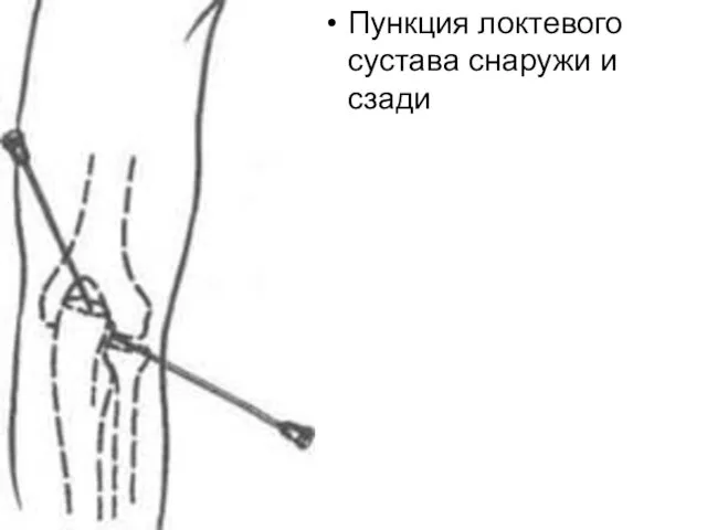 Пункция локтевого сустава снаружи и сзади