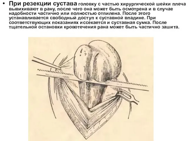 При резекции сустава головку с частью хирургической шейки плеча вывихивают