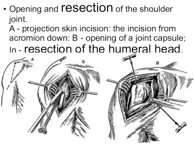 Opening and resection of the shoulder joint. A - projection