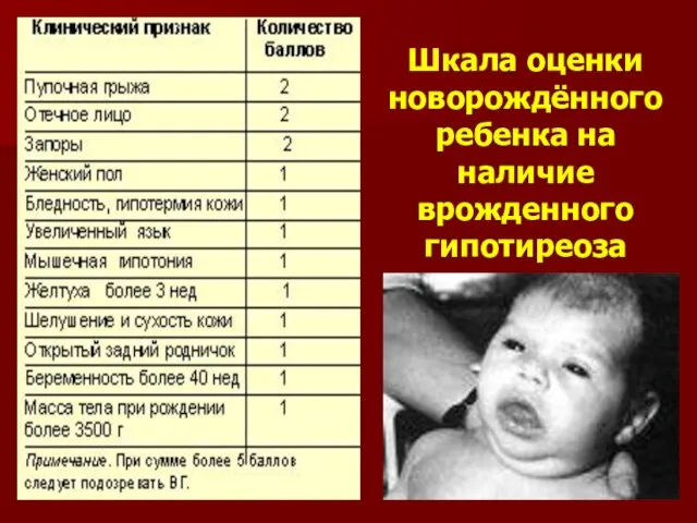 Шкала оценки новорождённого ребенка на наличие врожденного гипотиреоза