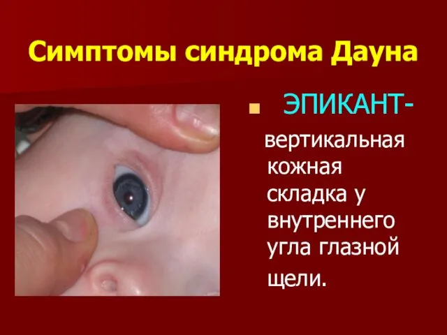 Симптомы синдрома Дауна ЭПИКАНТ- вертикальная кожная складка у внутреннего угла глазной щели.