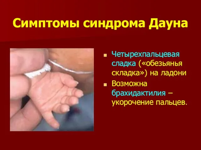 Симптомы синдрома Дауна Четырехпальцевая сладка («обезьянья складка») на ладони Возможна брахидактилия – укорочение пальцев.