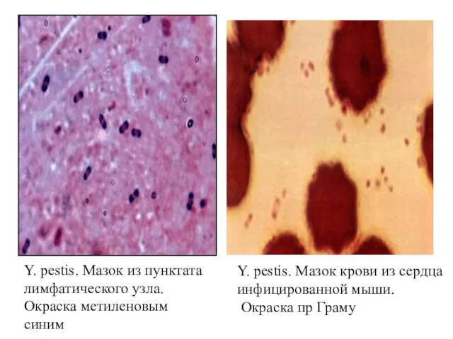Y. pestis. Мазок из пунктата лимфатического узла. Окраска метиленовым синим