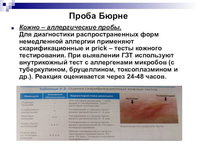 Проба Бюрне Кожно – аллергические пробы. Для диагностики распространенных форм