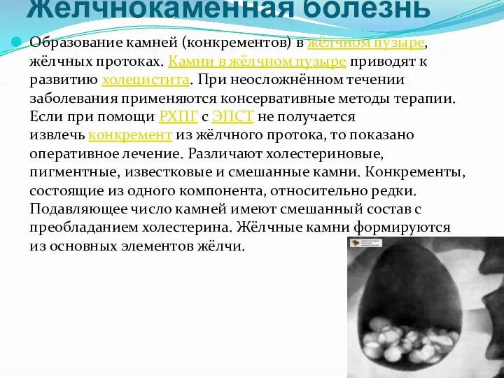 Жёлчнокаменная болезнь Образование камней (конкрементов) в жёлчном пузыре, жёлчных протоках.